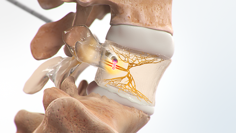 medical photo of the vertabrae receiving an intracept injection